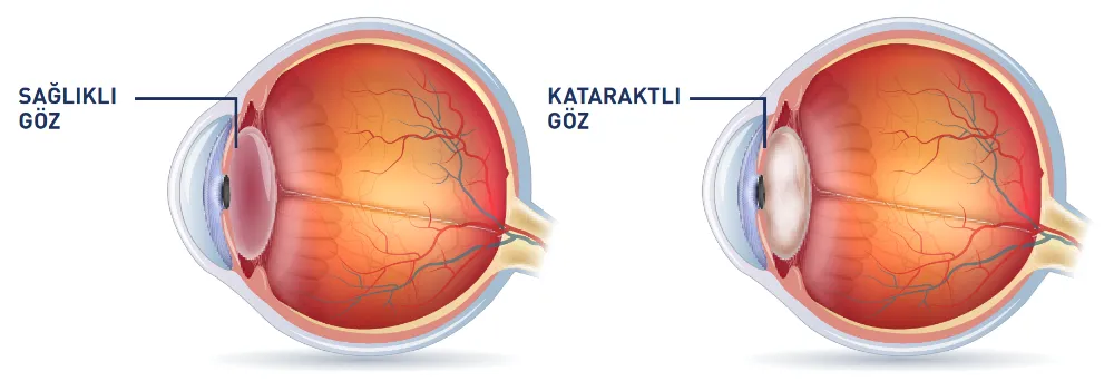 GÖZLERDEKİ SİS PERDESİ, “KATARAKT”